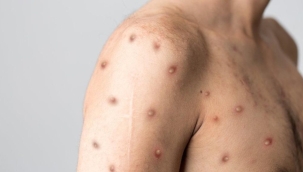 DSÖ: Küresel maymun çiçeği vakalarının sayısı 18 bini aştı