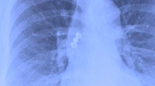 Sabah uyandı, dişleri yoktu! Röntgeni gören doktorlar şok oldu