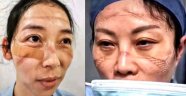 Koronavirüs salgınıyla mücadele eden sağlık görevlilerinin yüzlerinde maske izleri kaldı
